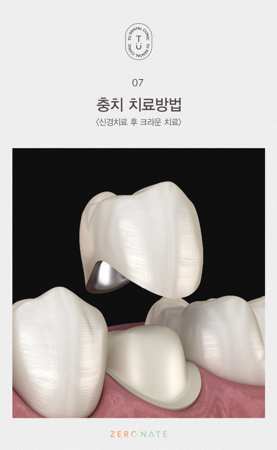 충치의 개선 제로네이트[TU치과] 관련 이미지 8
