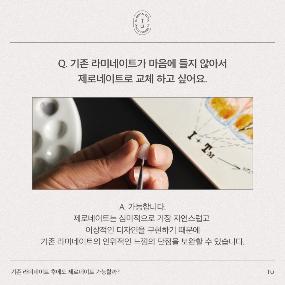 [티유치과] 기존 라미네이트를 제로네이트로 교체도 가능할까요?[TU치과] 관련 이미지 2