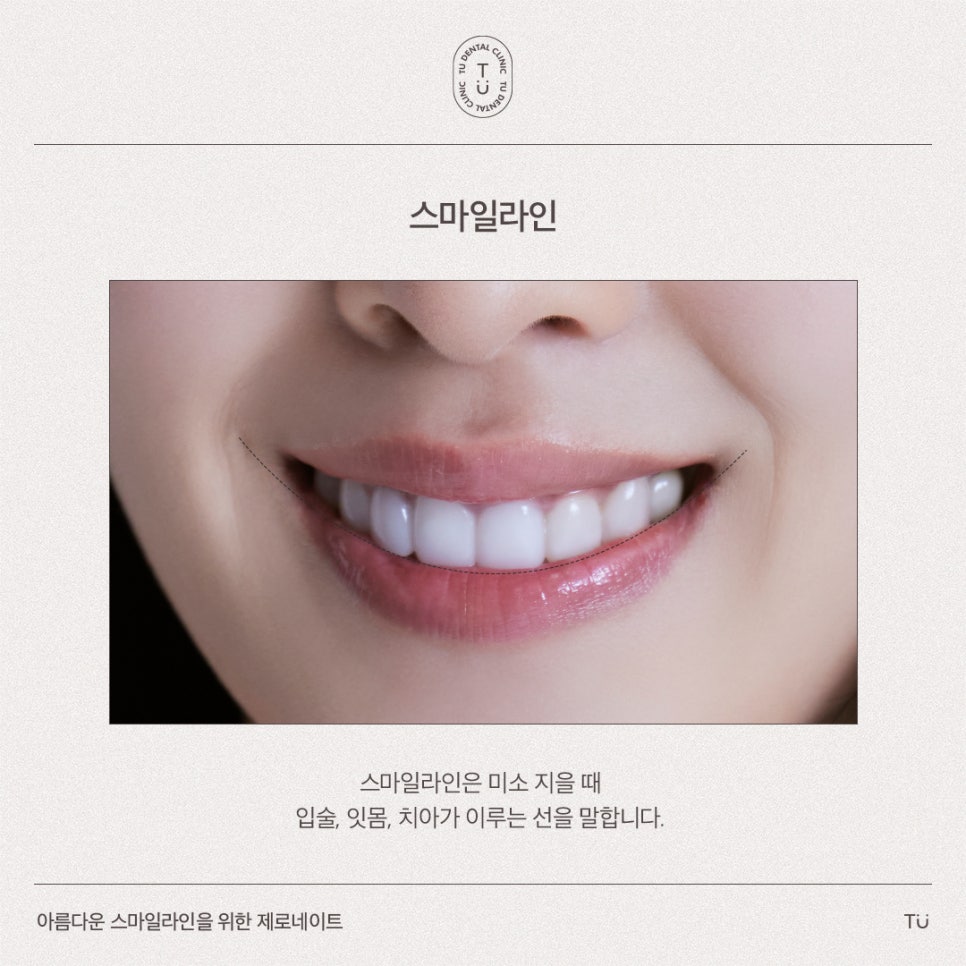 [티유치과] 아름다운 스마일라인을 위한 제로네이트 관련 이미지 2