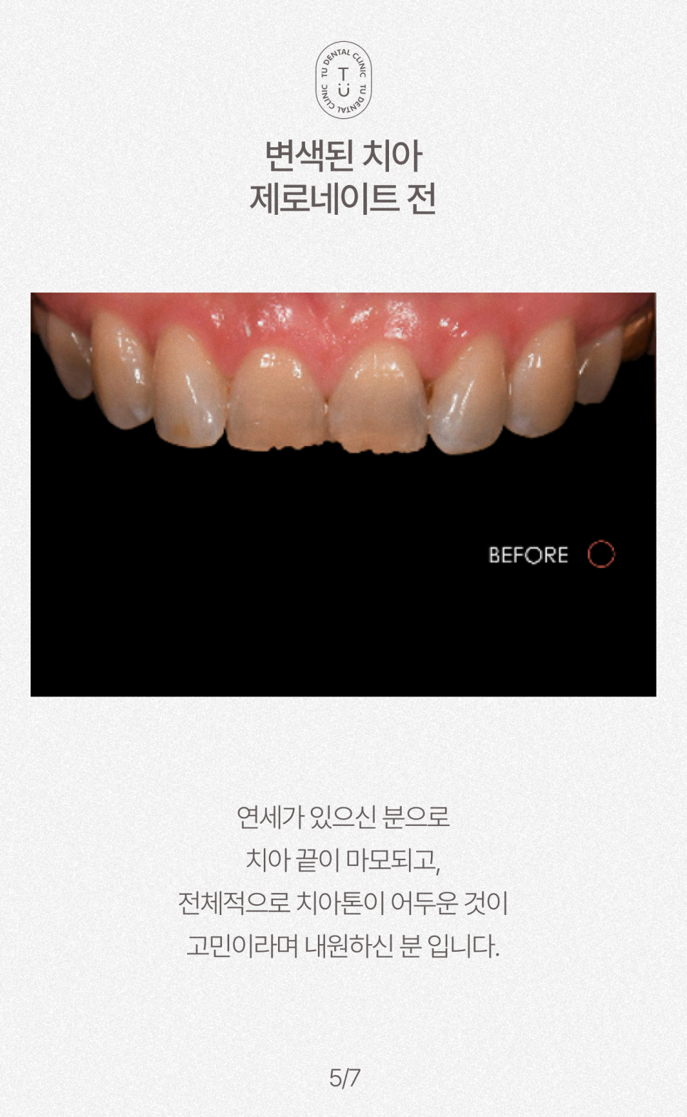 치아 반영구적으로 하얘지는 법, 티유치과[TU치과] 관련 이미지 6