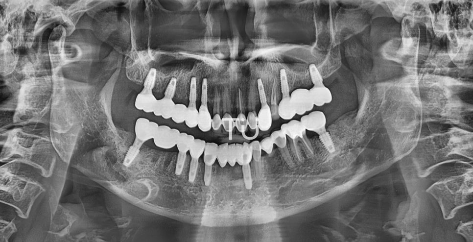 TU 임플란트 치료사례 : 구치부, 브릿지 관련 이미지 4
