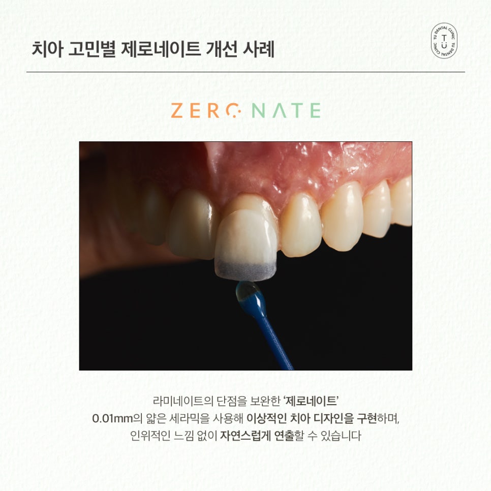 치아 고민별 제로네이트 개선 사례 (유형별 라미네이트 전후) 관련 이미지 3