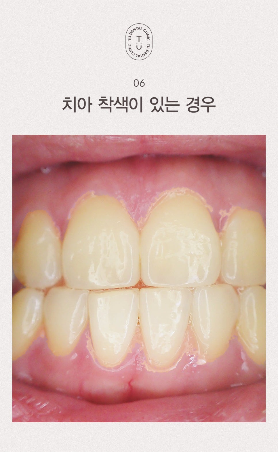 티유치과에서 치약 고르는 법 알려드립니다 [TU치과] 관련 이미지 8