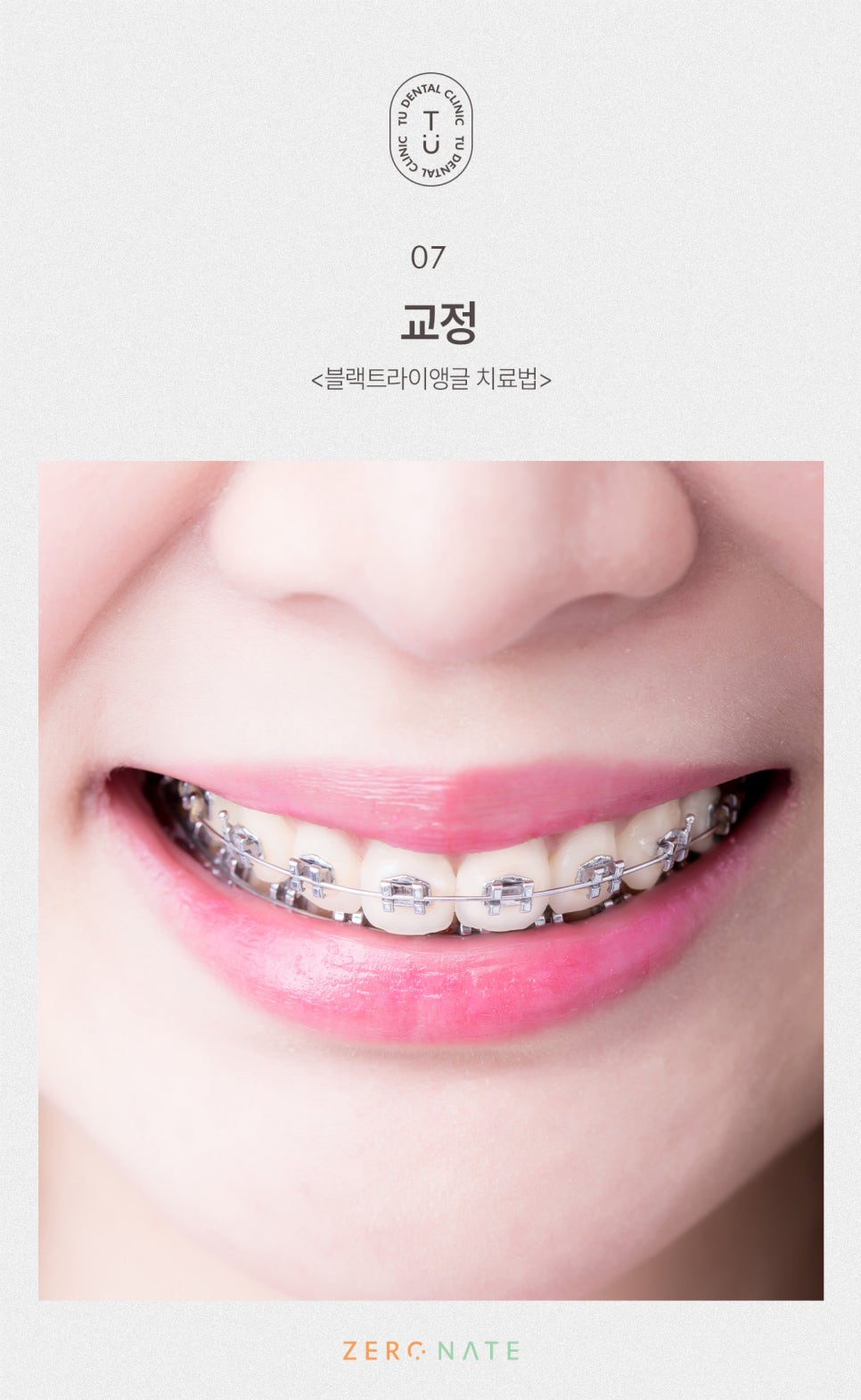 티유치과 블랙트라이앵글 제로네이트 [TU치과] 관련 이미지 8