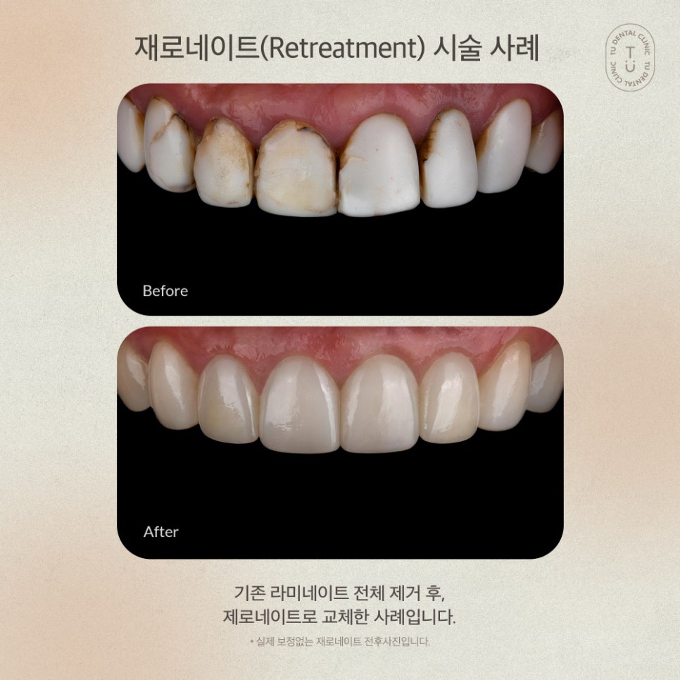 [티유치과] 기존 라미네이트를 제로네이트로 교체도 가능할까요?[TU치과] 관련 이미지 6