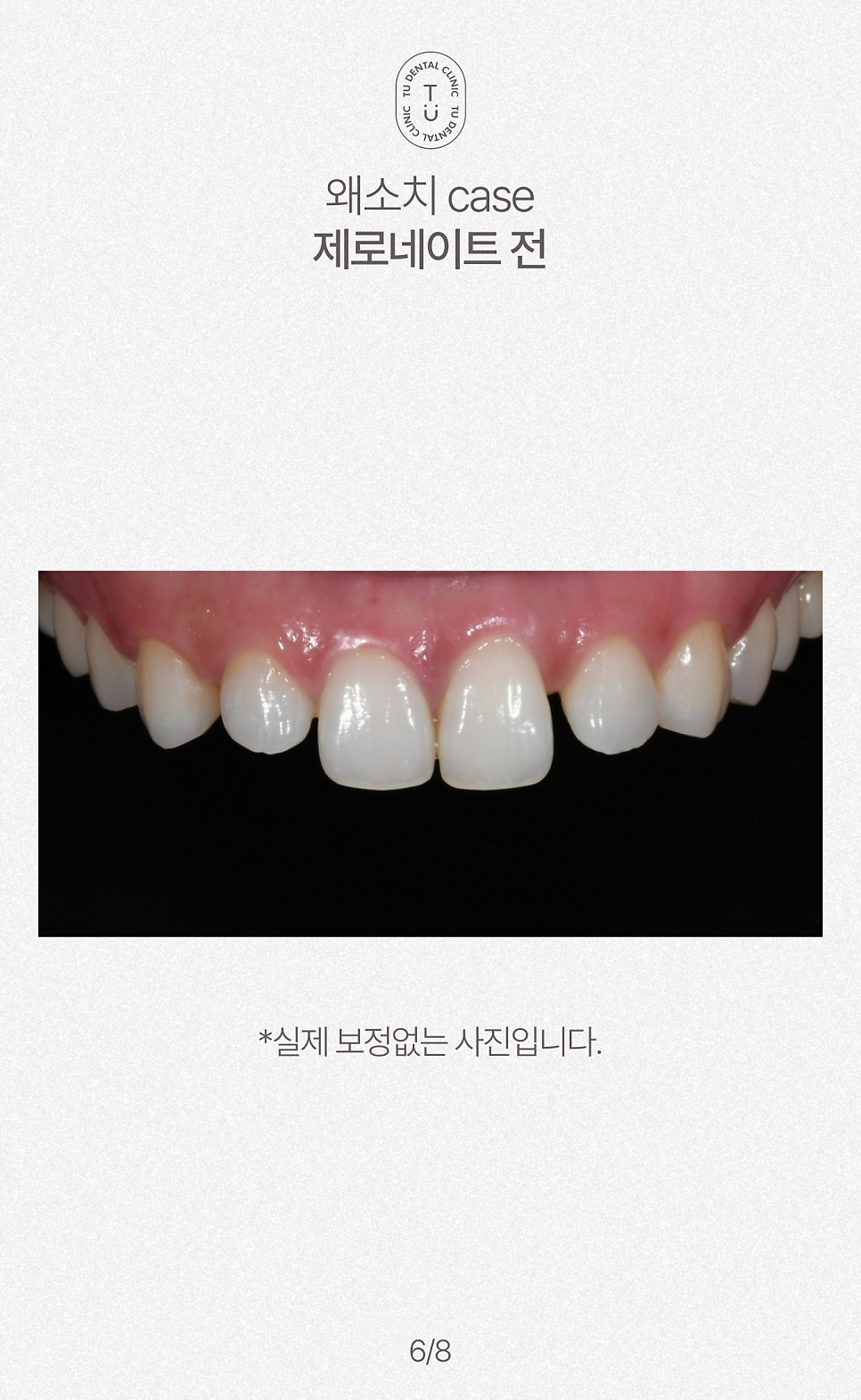 왜소치 치료방법, 작은치아 라미네이트, 제로네이트 알려드립니다! 티유치과[TU치과] 관련 이미지 7