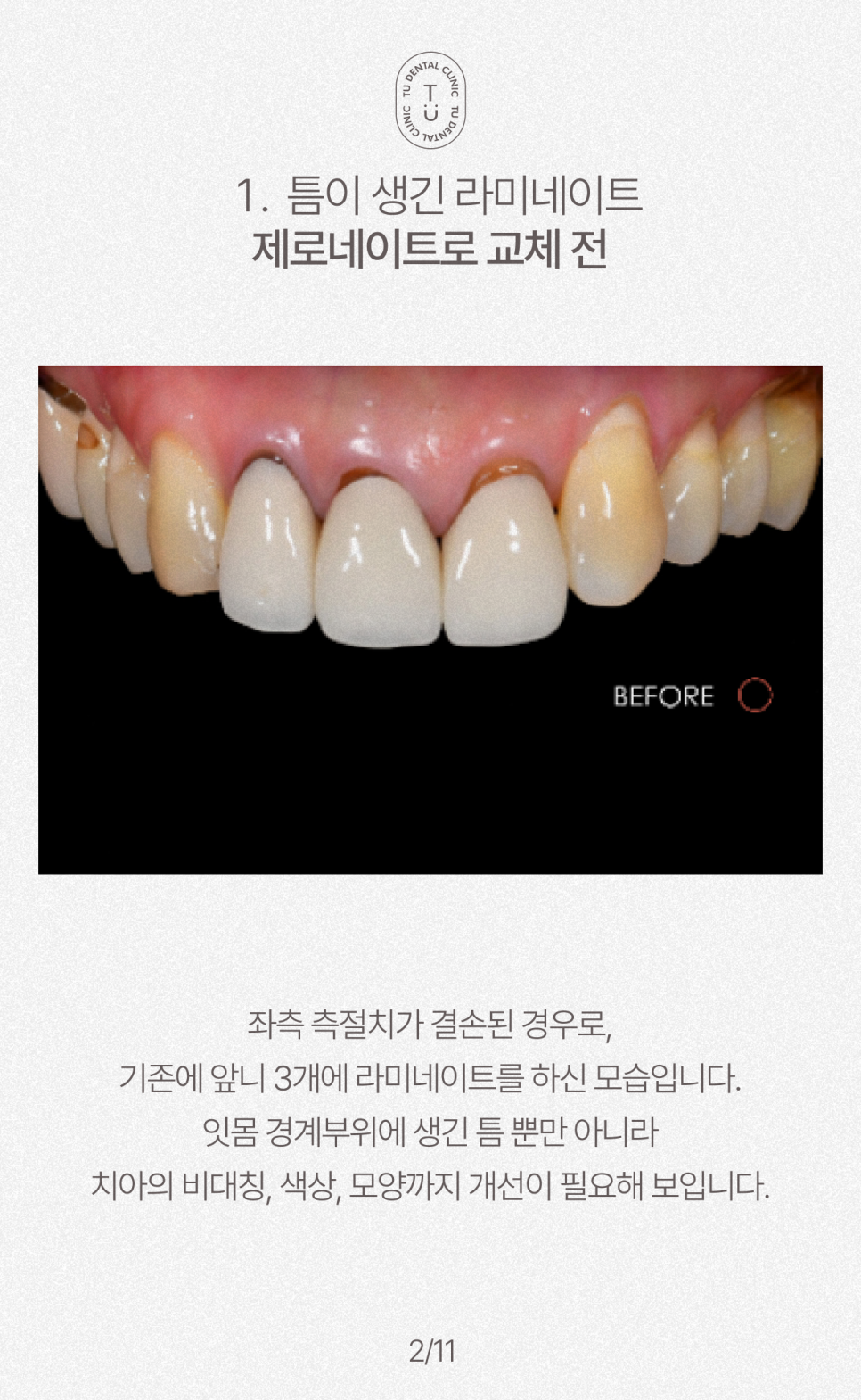 오래된 라미네이트 교체하셔야 됩니다, 티유치과[TU치과] 관련 이미지 3