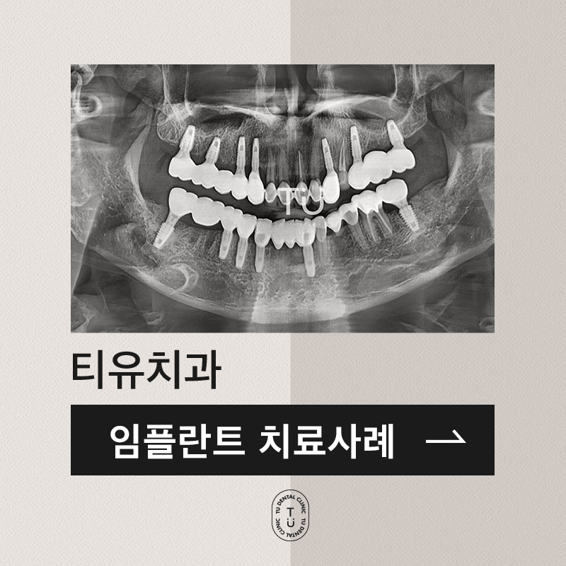 TU 임플란트 치료사례 : 구치부, 브릿지 관련 이미지 1