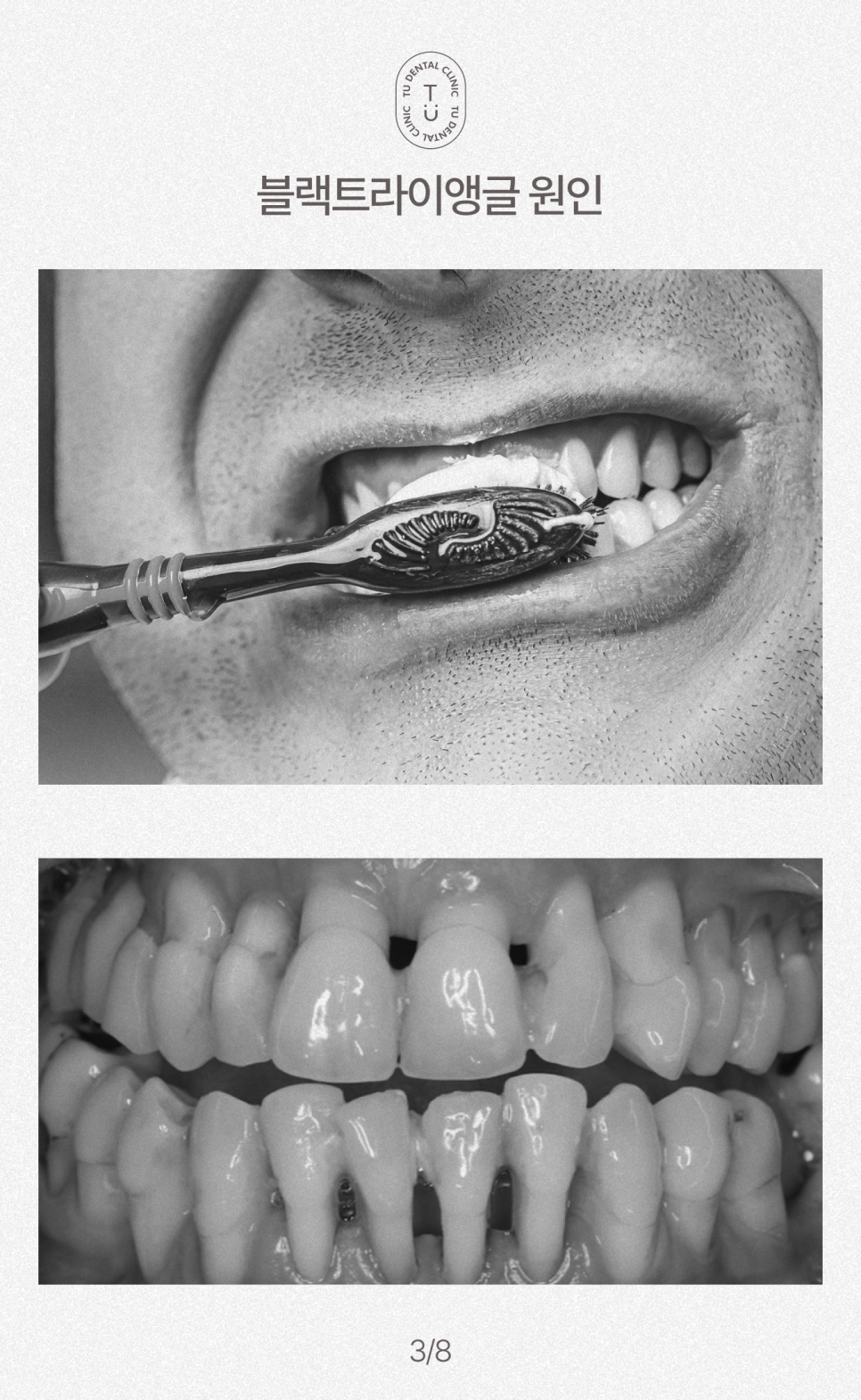 치아 사이 구멍, 블랙트라이앵글 제로네이트로 해결하세요 관련 이미지 4