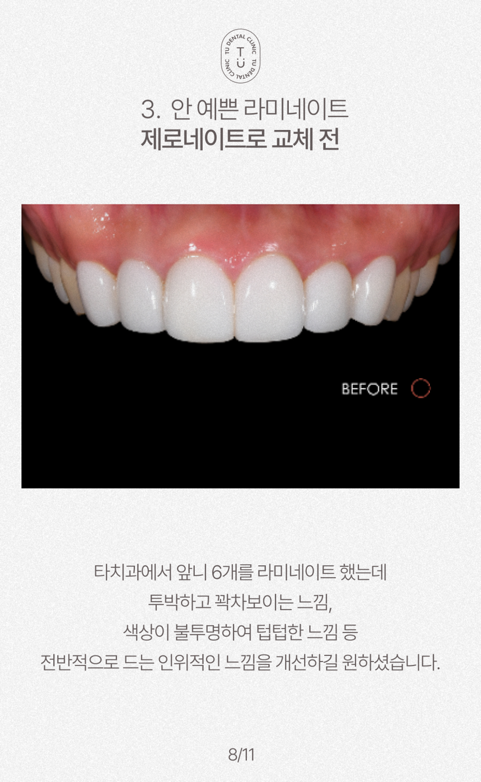 오래된 라미네이트 교체하셔야 됩니다, 티유치과[TU치과] 관련 이미지 9