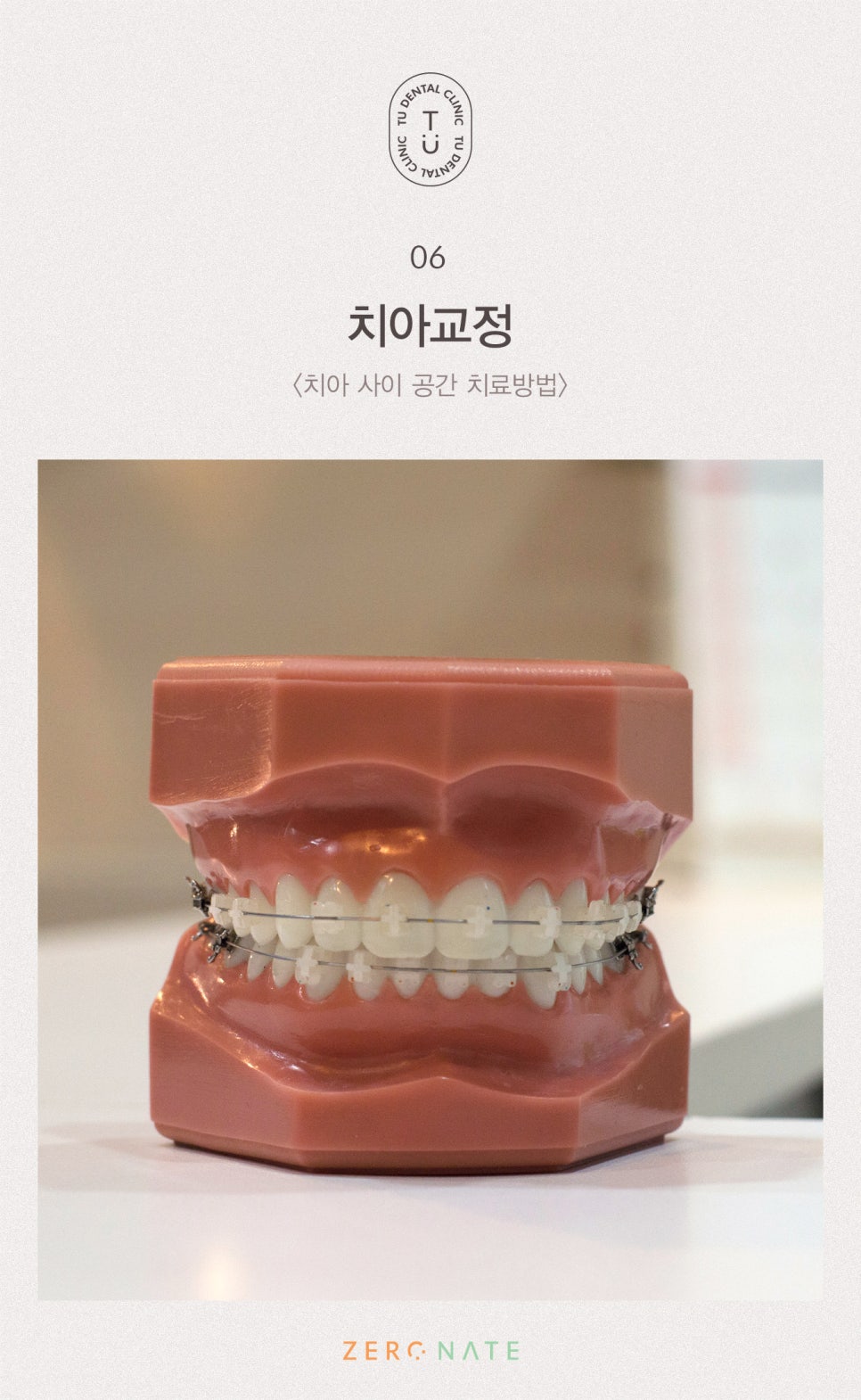 치아 사이 공간 치료방법, 티유치과[TU치과] 관련 이미지 7