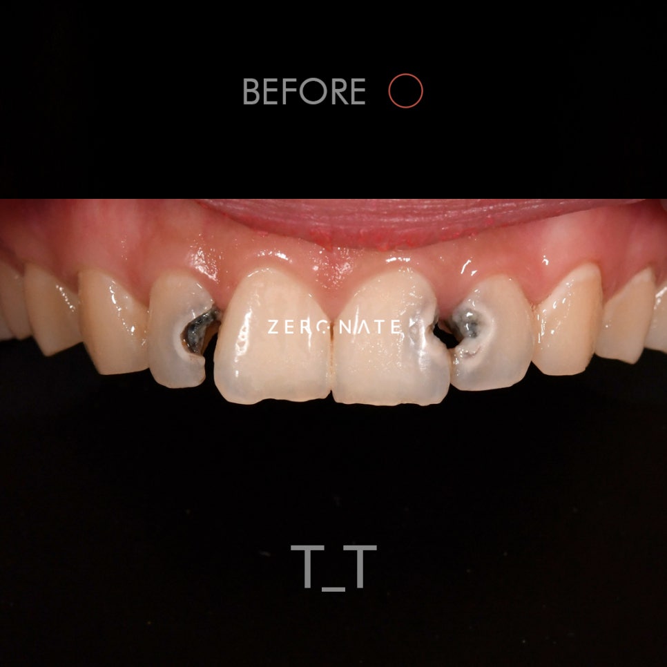 TU 제로네이트 사례 : 심한충치의 개선 관련 이미지 2