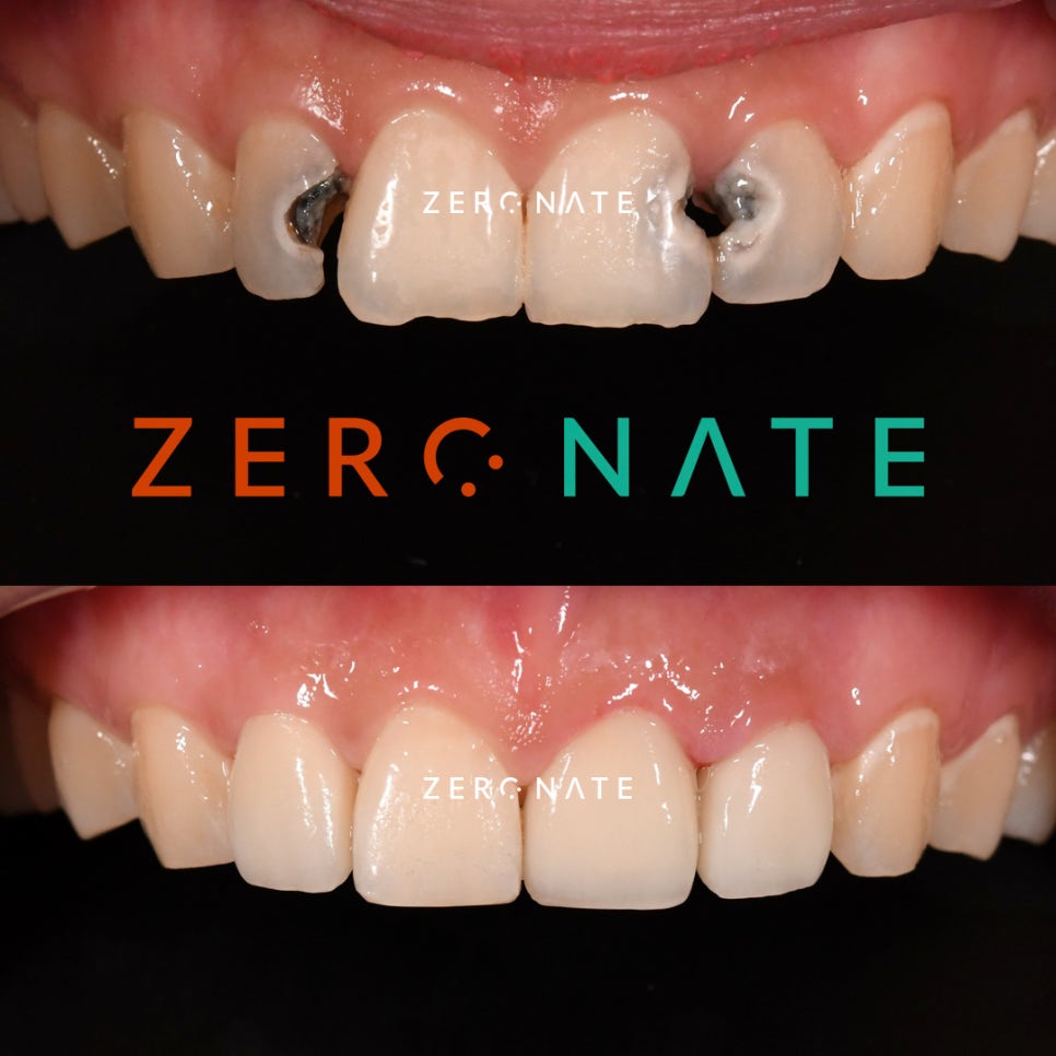 TU 제로네이트 사례 : 심한충치의 개선 관련 이미지 4