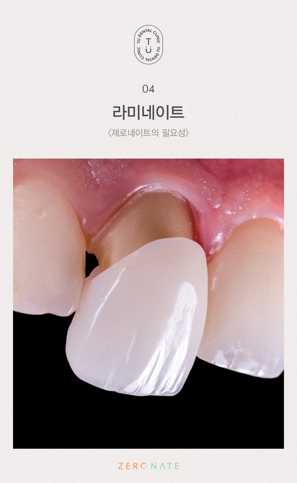 티유치과 제로네이트 부작용에 대해 설명드립니다 [TU치과] 관련 이미지 5