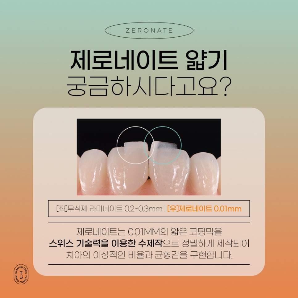 기존 자연치아를 보존하는 라미네이트 방법은? 관련 이미지 5