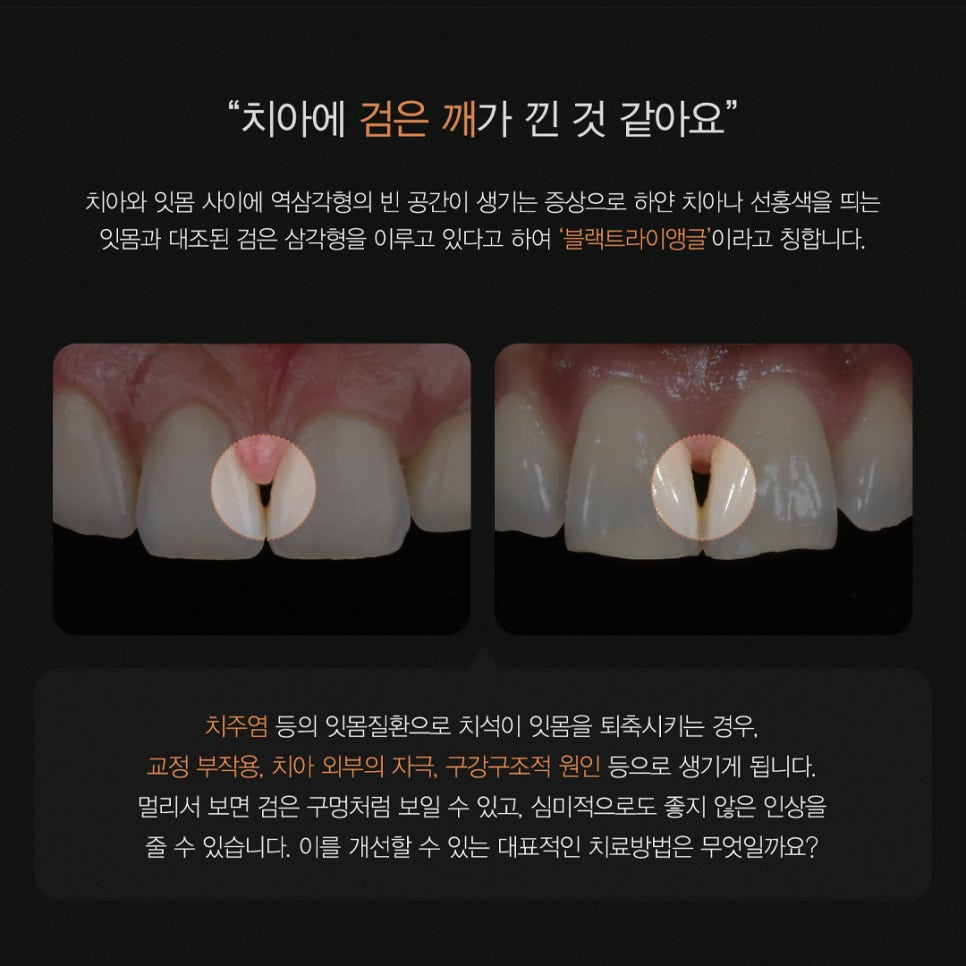 티유치과 4월 매거진, 블랙트라이앵글 치아의 치료법 [TU치과] 관련 이미지 2