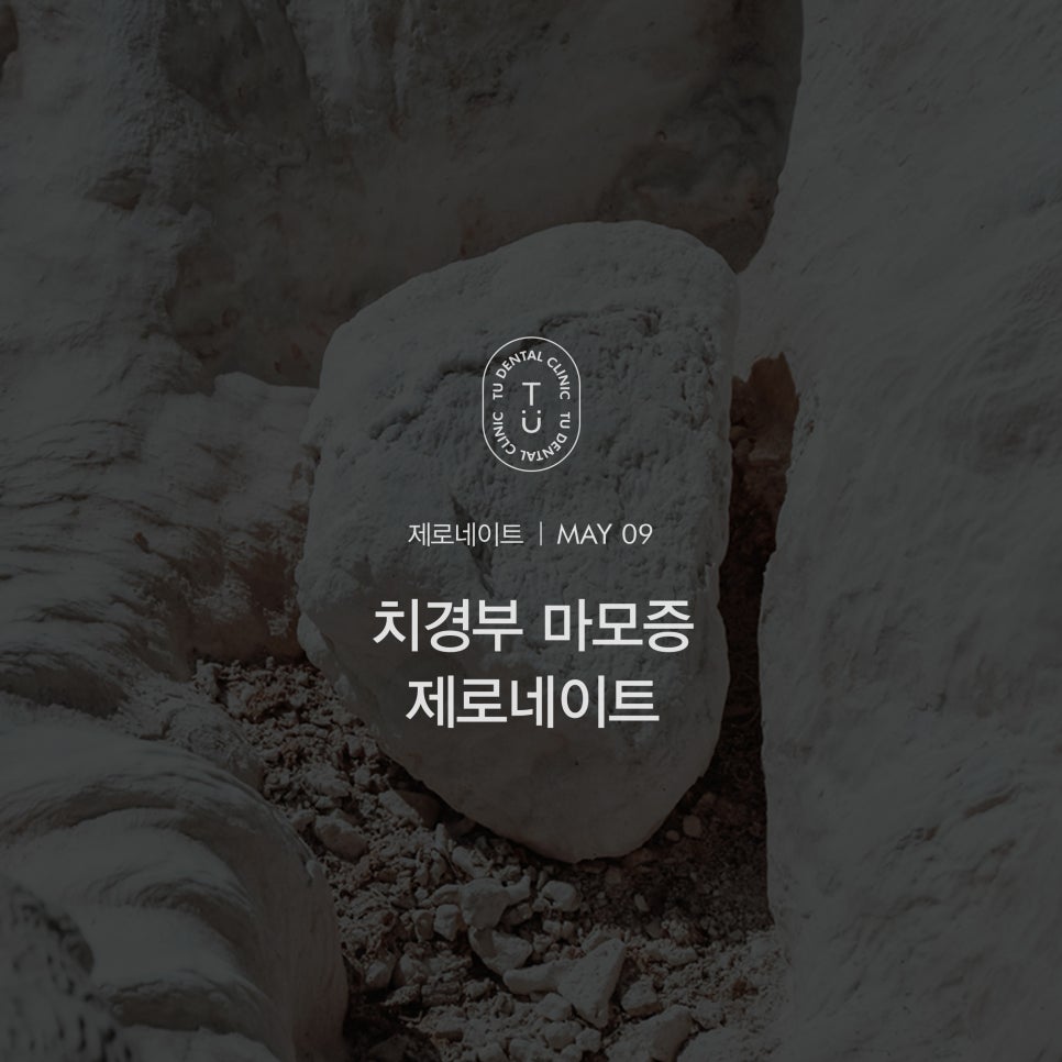 치경부 마모증 치료방법, 티유치과 제로네이트[TU치과] 관련 이미지 1