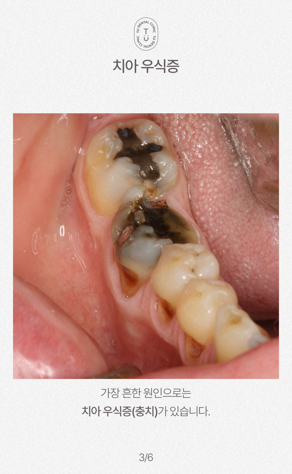 여름철, 이 시린이유가 뭘까요? 티유치과[TU치과] 관련 이미지 4