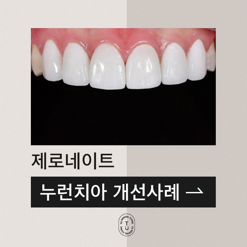 누렇게 변색된 치아의 개선 case : 제로네이트 관련 이미지 1