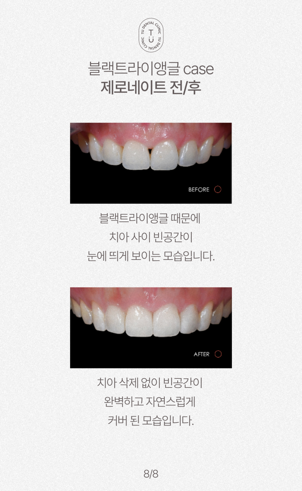 치아 사이 구멍, 블랙트라이앵글 제로네이트로 해결하세요 관련 이미지 9