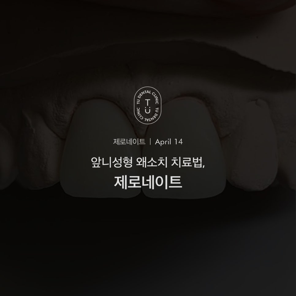 왜소치 라미네이트 제로네이트 자연스러운 미소를 되찾는 앞니성형 관련 이미지 1
