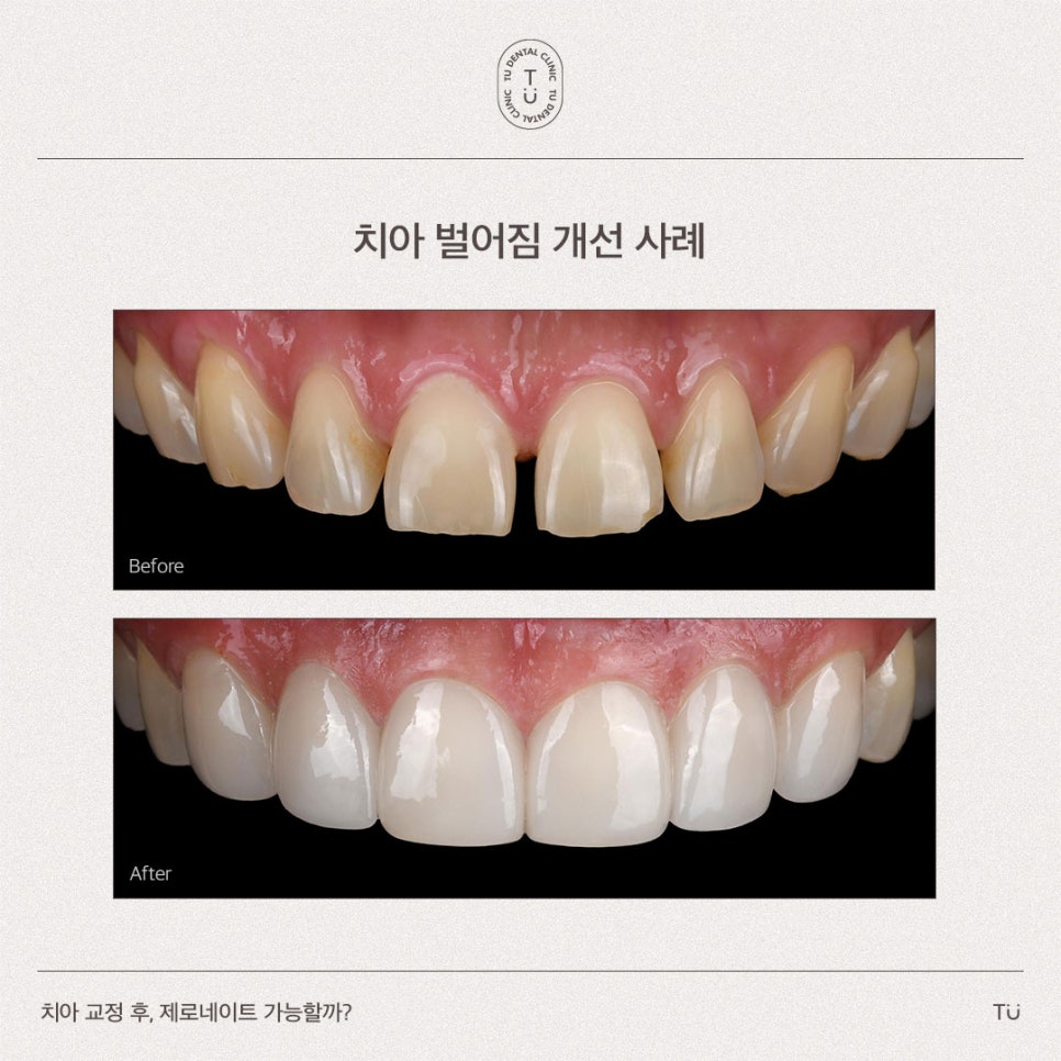 [티유치과] 치아 교정 후, 제로네이트 가능할까요?[TU치과] 관련 이미지 5