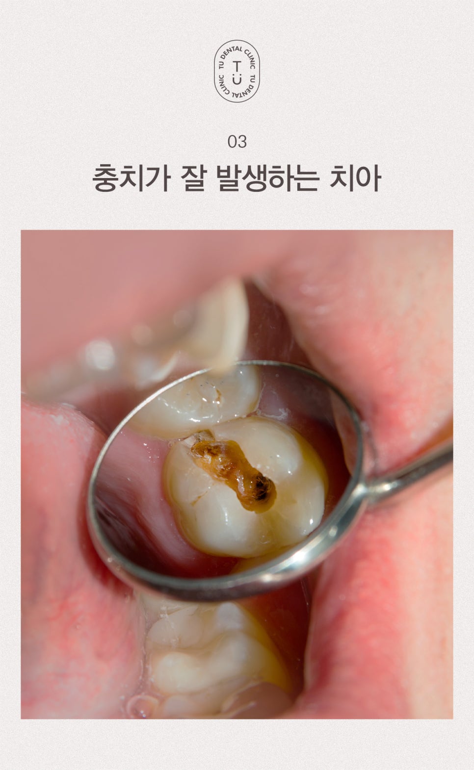 티유치과에서 치약 고르는 법 알려드립니다 [TU치과] 관련 이미지 4