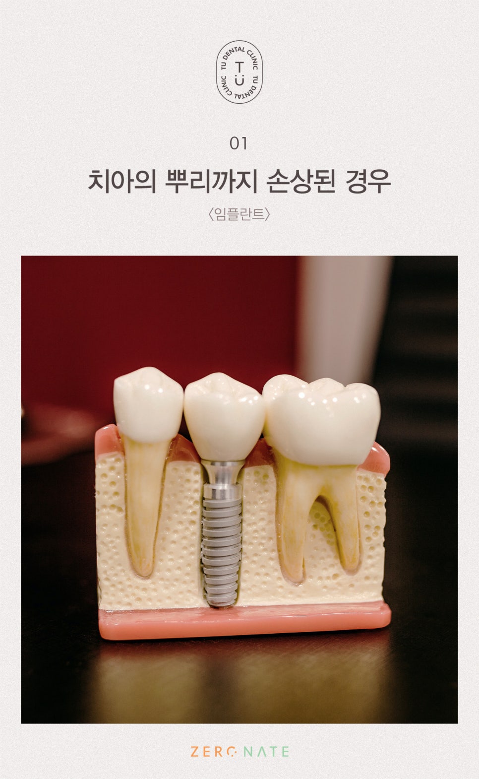 파절된 치아 치료방법, 티유치과[TU치과] 관련 이미지 2