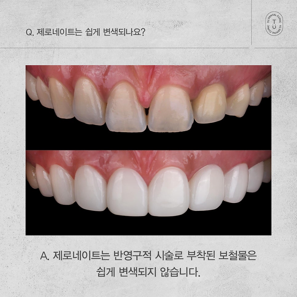 제로네이트 자주 묻는 질문 FAQ ｜ PART.1[TU치과] 관련 이미지 5