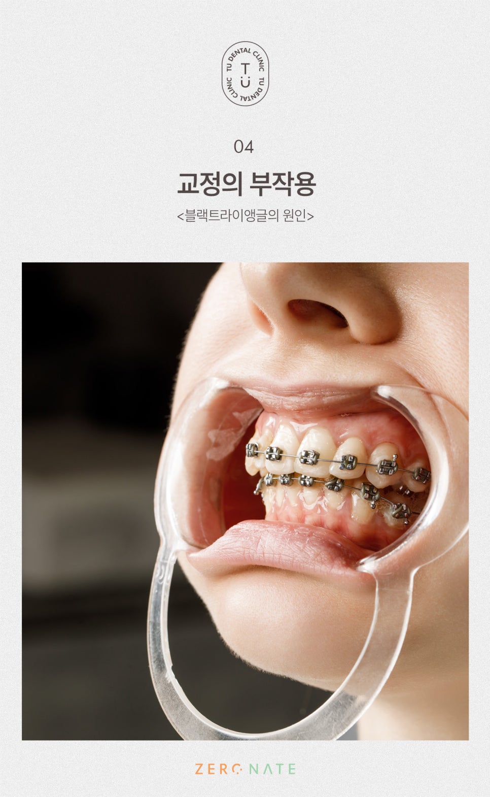 티유치과 블랙트라이앵글 제로네이트 [TU치과] 관련 이미지 5