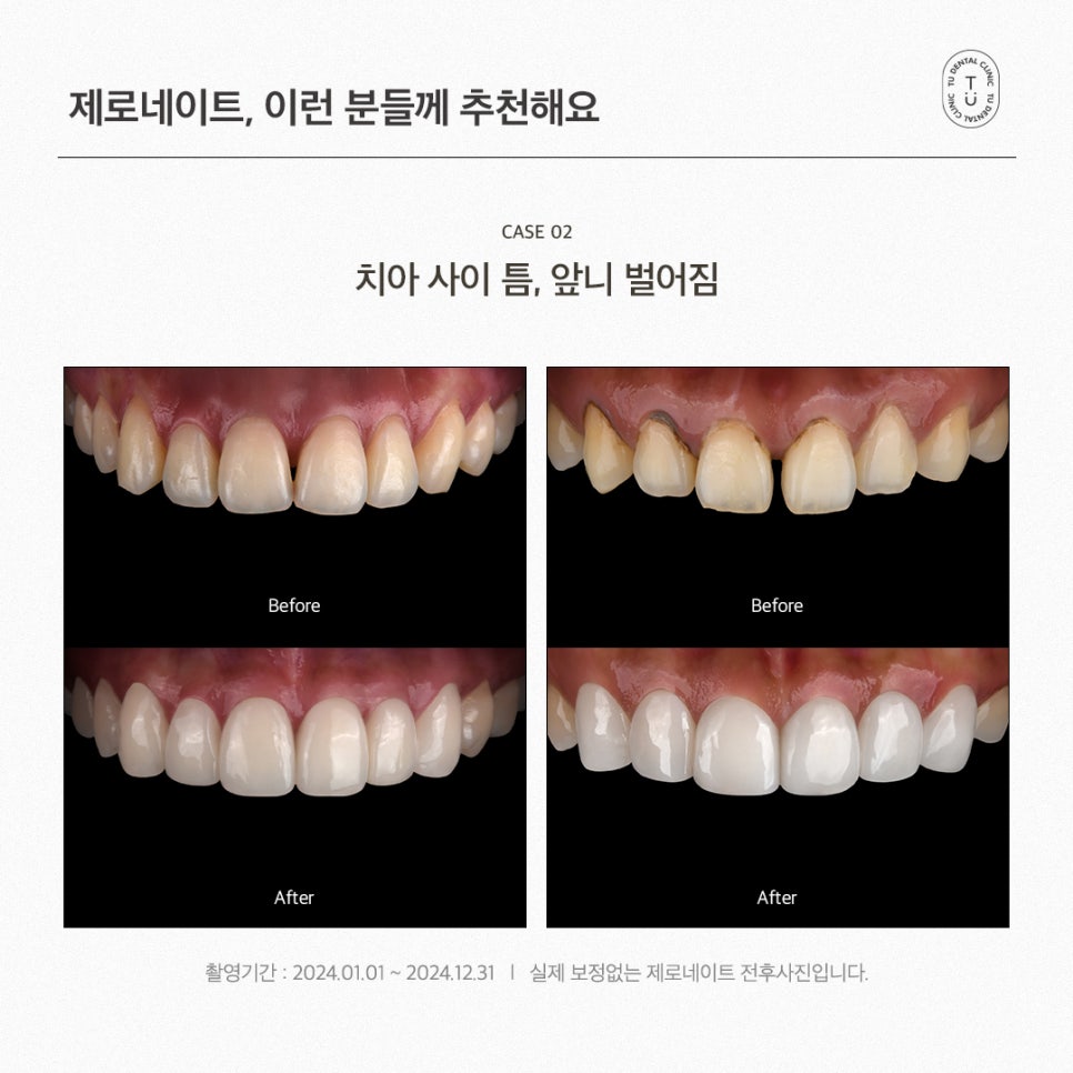 내 치아도 제로네이트 될까? (제로네이트 후기) 관련 이미지 6
