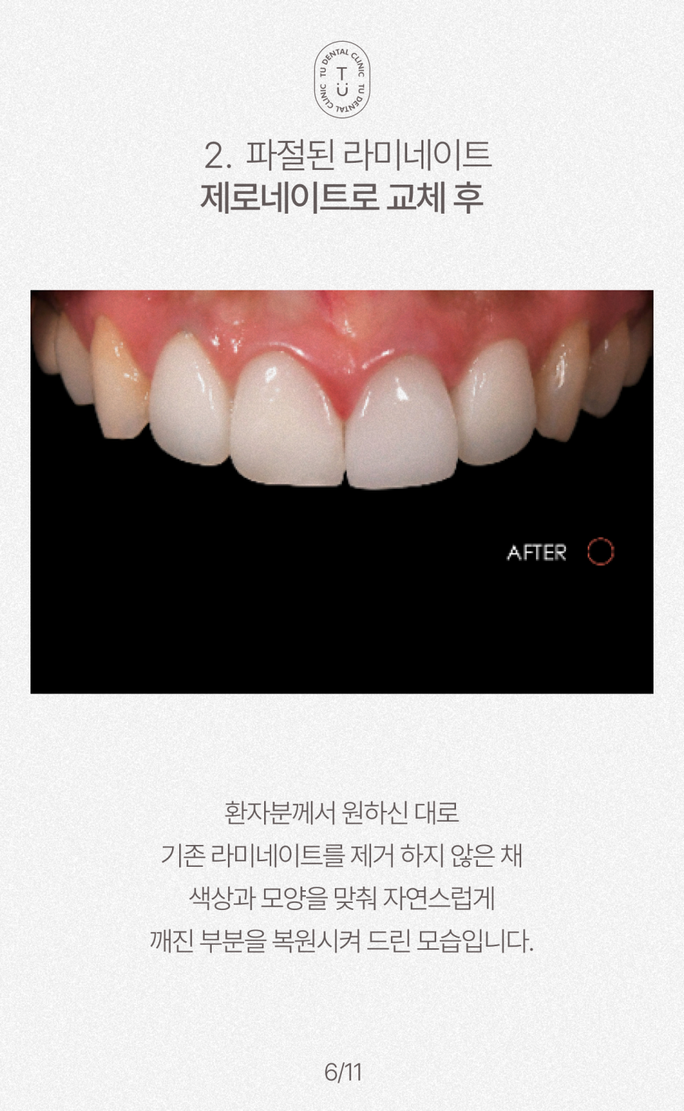 오래된 라미네이트 교체하셔야 됩니다, 티유치과[TU치과] 관련 이미지 7