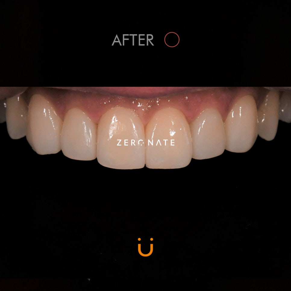 제로네이트 : 치아길이의 개선 사례 관련 이미지 4