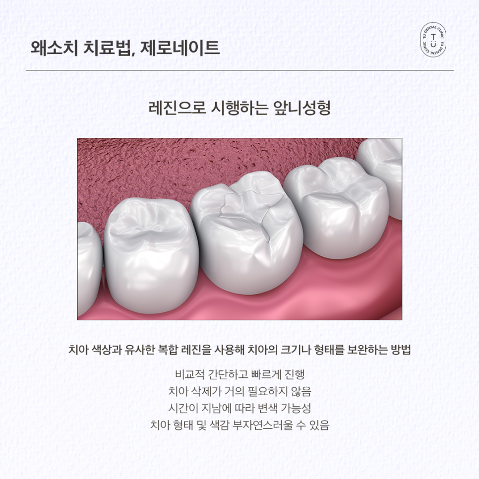 왜소치 라미네이트 제로네이트 자연스러운 미소를 되찾는 앞니성형 관련 이미지 3