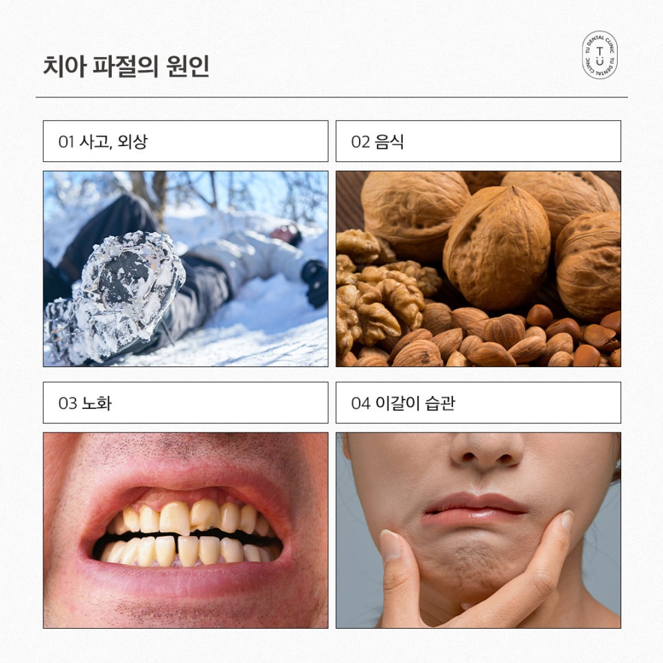 [티유치과] 치아 파절의 치료법, 제로네이트 관련 이미지 3