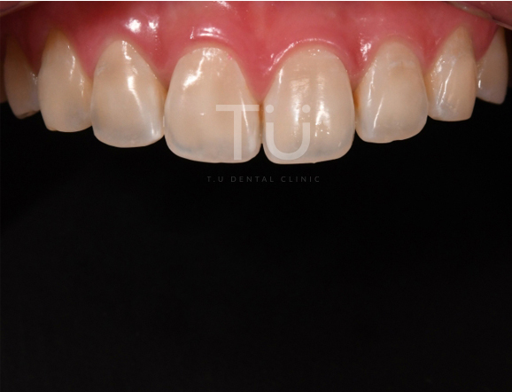 누렇게 변색된 치아의 개선 case : 제로네이트 관련 이미지 2