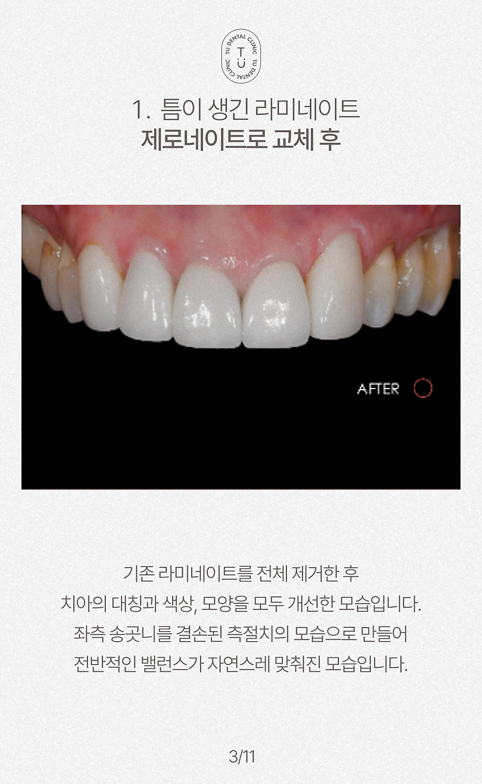 오래된 라미네이트 교체하셔야 됩니다, 티유치과[TU치과] 관련 이미지 4