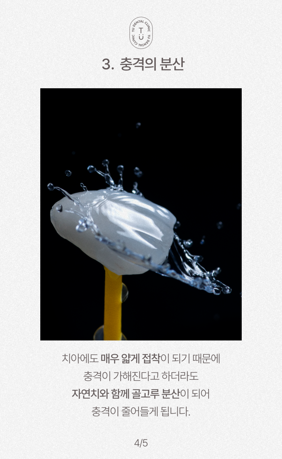 무삭제 라미네이트, 제로네이트 깨질까봐 걱정이신가요? [TU치과] 관련 이미지 5