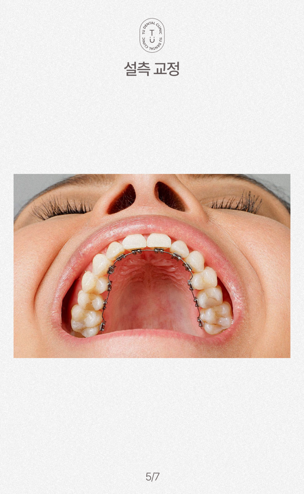 철도의 날, 삐뚤빼뚤한 치아에 철도공사하세요! 티유치과[TU치과] 관련 이미지 6