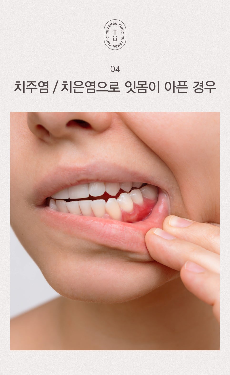 티유치과에서 치약 고르는 법 알려드립니다 [TU치과] 관련 이미지 5