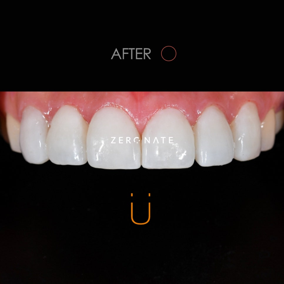 깨진 앞니 치료 제로네이트 사례 : 티유치과 관련 이미지 3