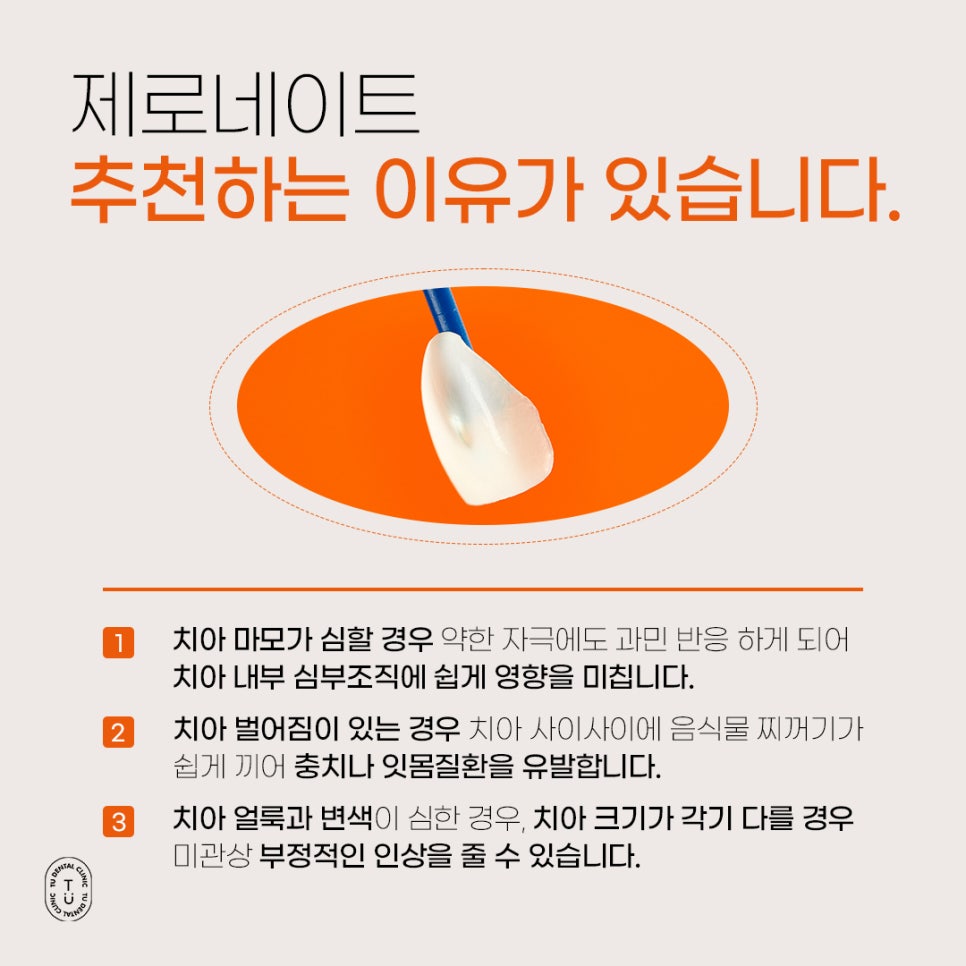 기존 자연치아를 보존하는 라미네이트 방법은? 관련 이미지 3
