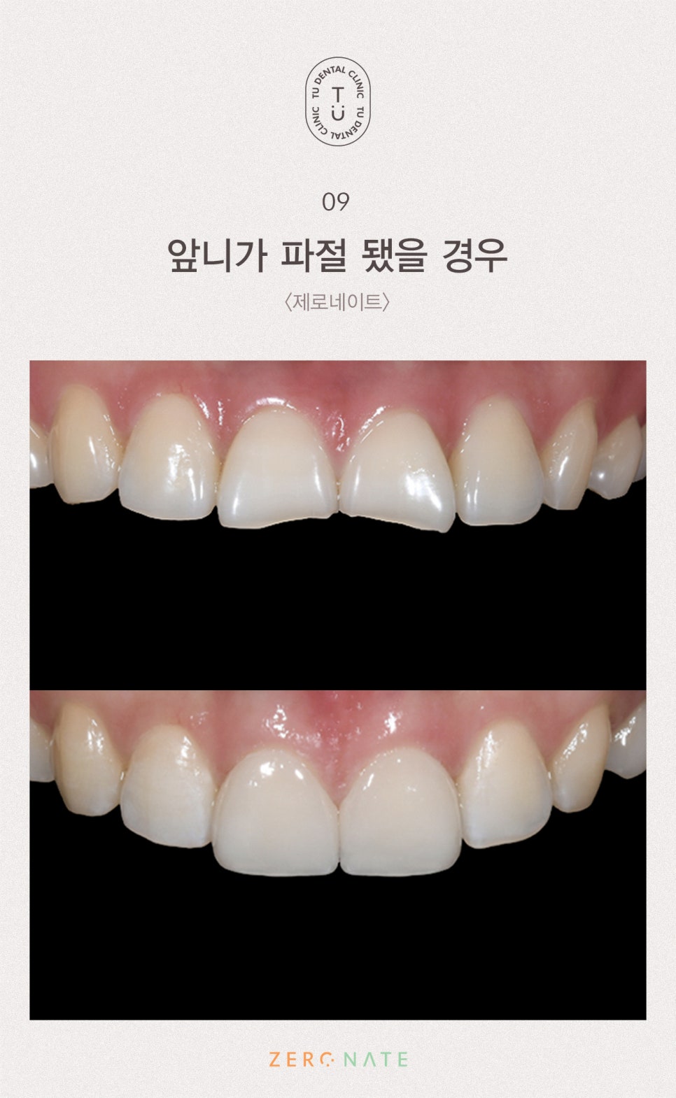 파절된 치아 치료방법, 티유치과[TU치과] 관련 이미지 10