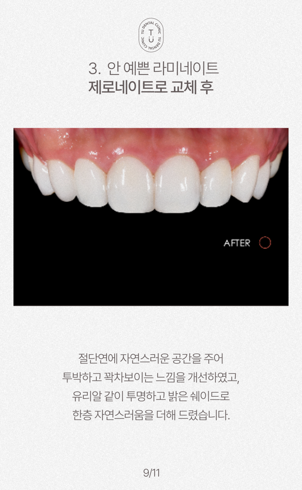 오래된 라미네이트 교체하셔야 됩니다, 티유치과[TU치과] 관련 이미지 10