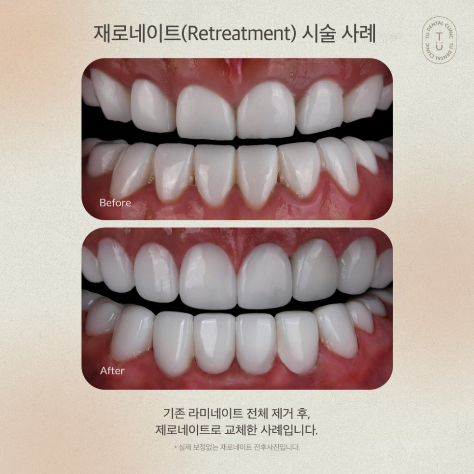 [티유치과] 기존 라미네이트를 제로네이트로 교체도 가능할까요?[TU치과] 관련 이미지 7