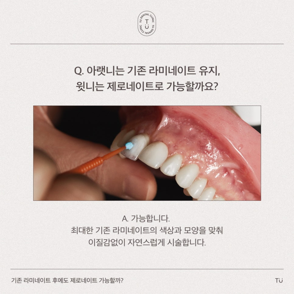 [티유치과] 기존 라미네이트를 제로네이트로 교체도 가능할까요?[TU치과] 관련 이미지 4