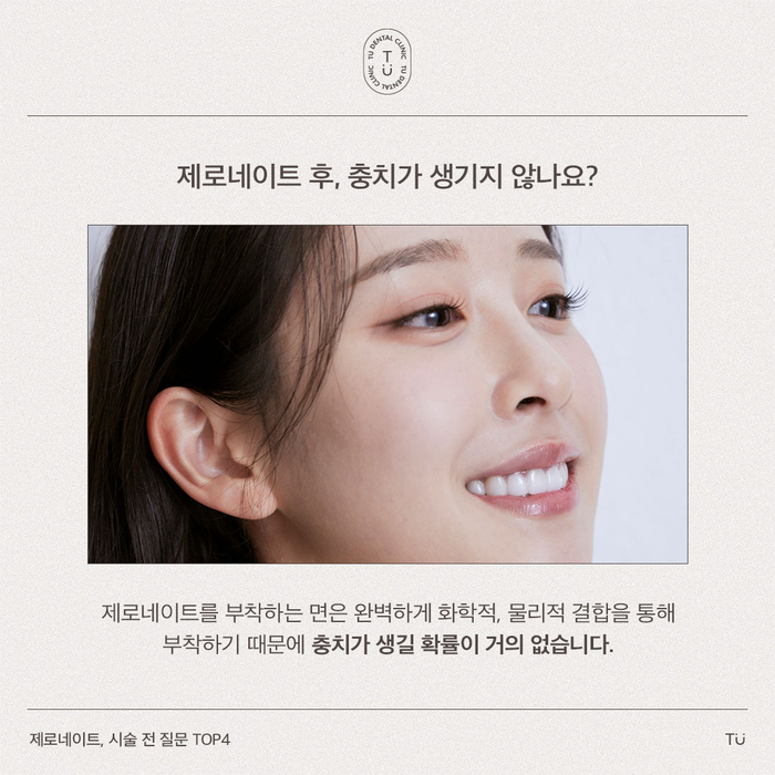[티유치과] 제로네이트, 시술 전 질문 TOP4 [TU치과] 관련 이미지 4