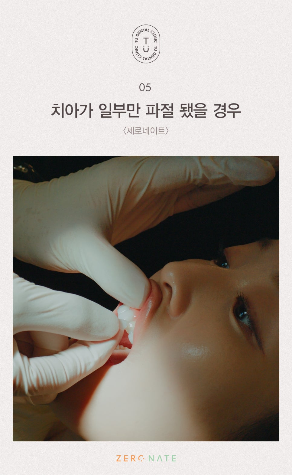 파절된 치아 치료방법, 티유치과[TU치과] 관련 이미지 6