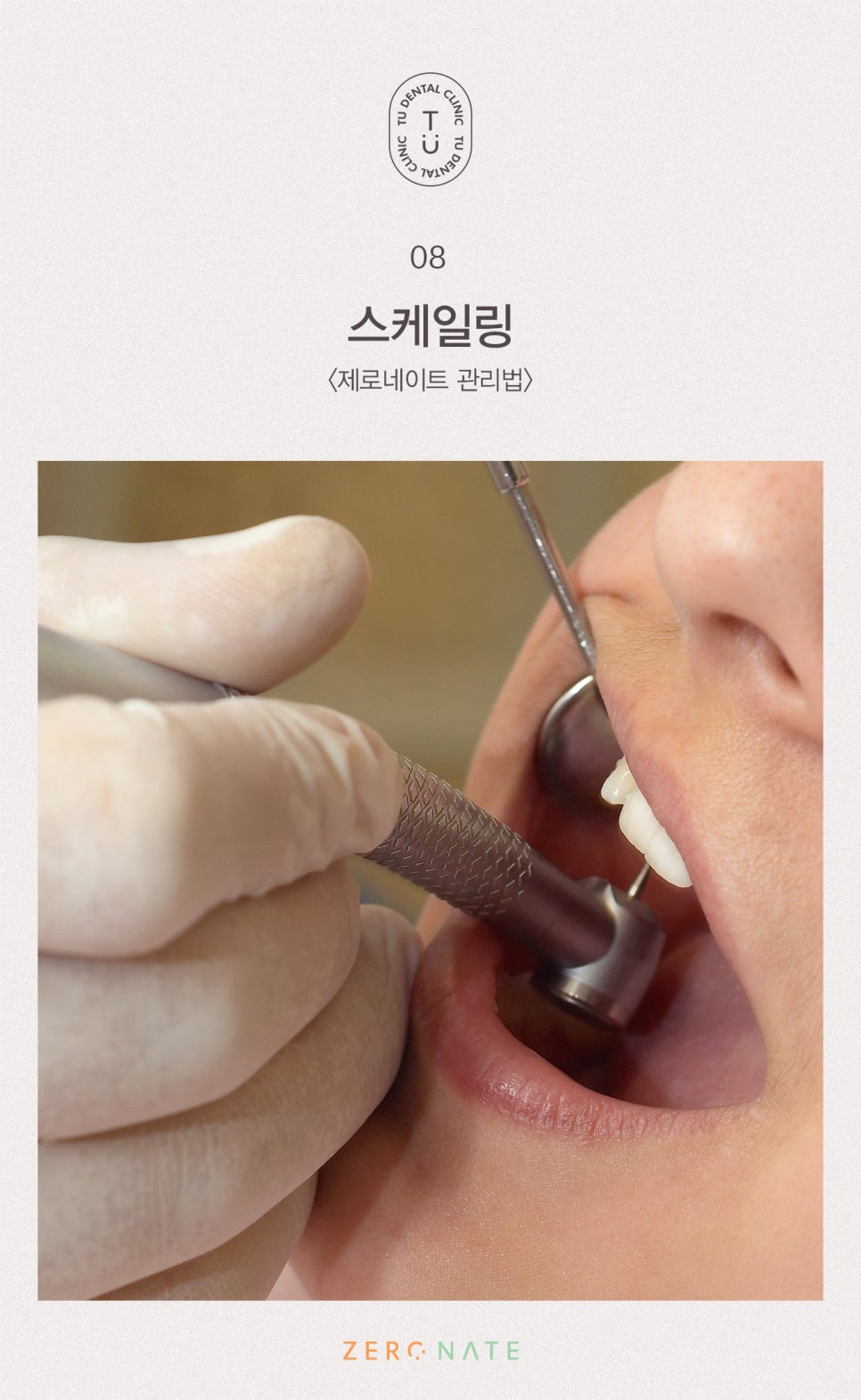 티유치과 제로네이트 관리법에 대해 알려드립니다 [TU치과] 관련 이미지 9