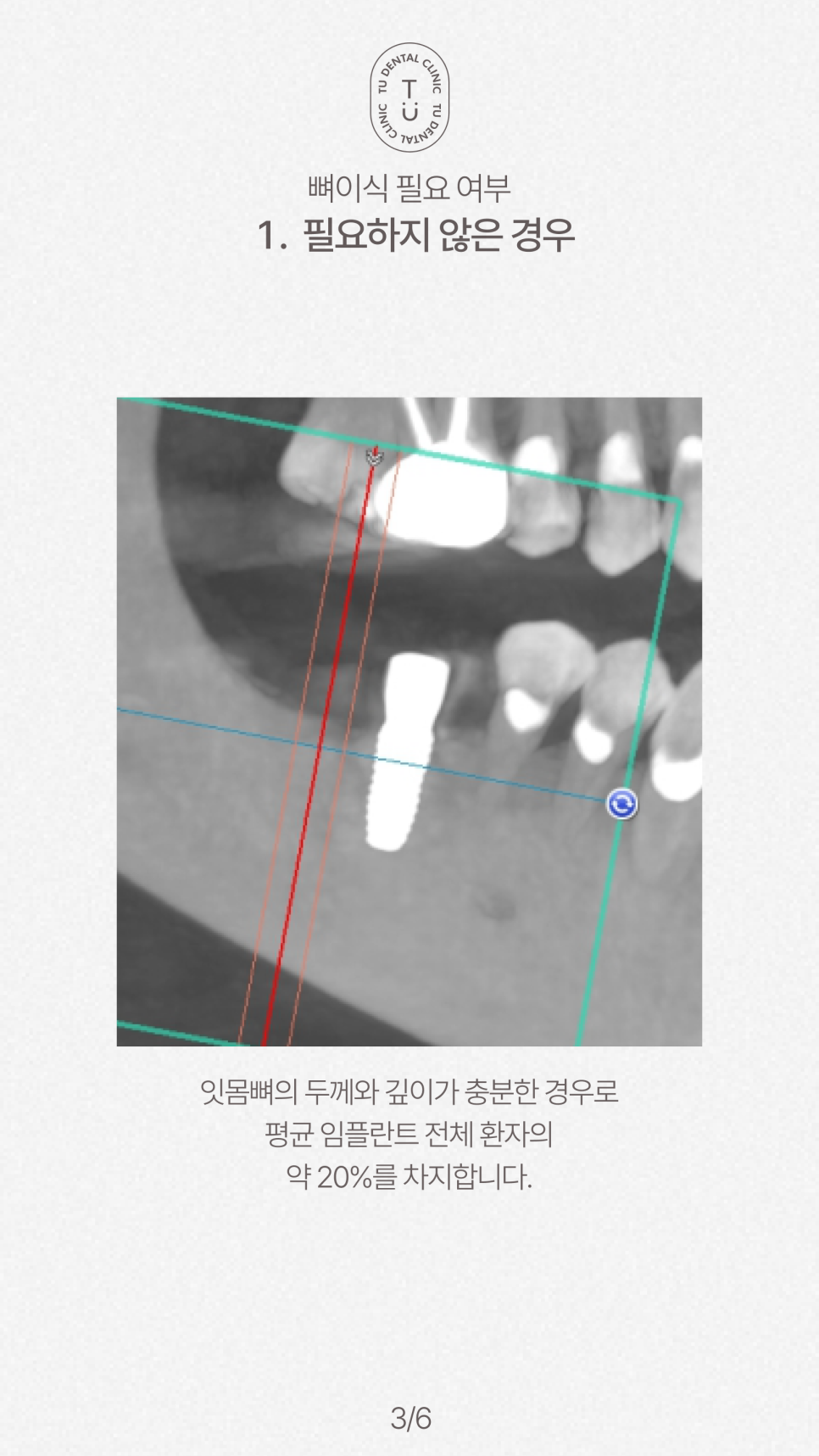 임플란트 뼈이식 꼭 해야할까요? 티유치과[TU치과] 관련 이미지 4